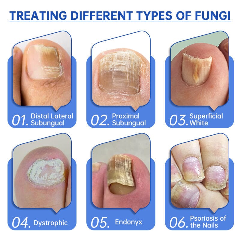 Furzero™ PureNail Fungus Laser Therapy Device